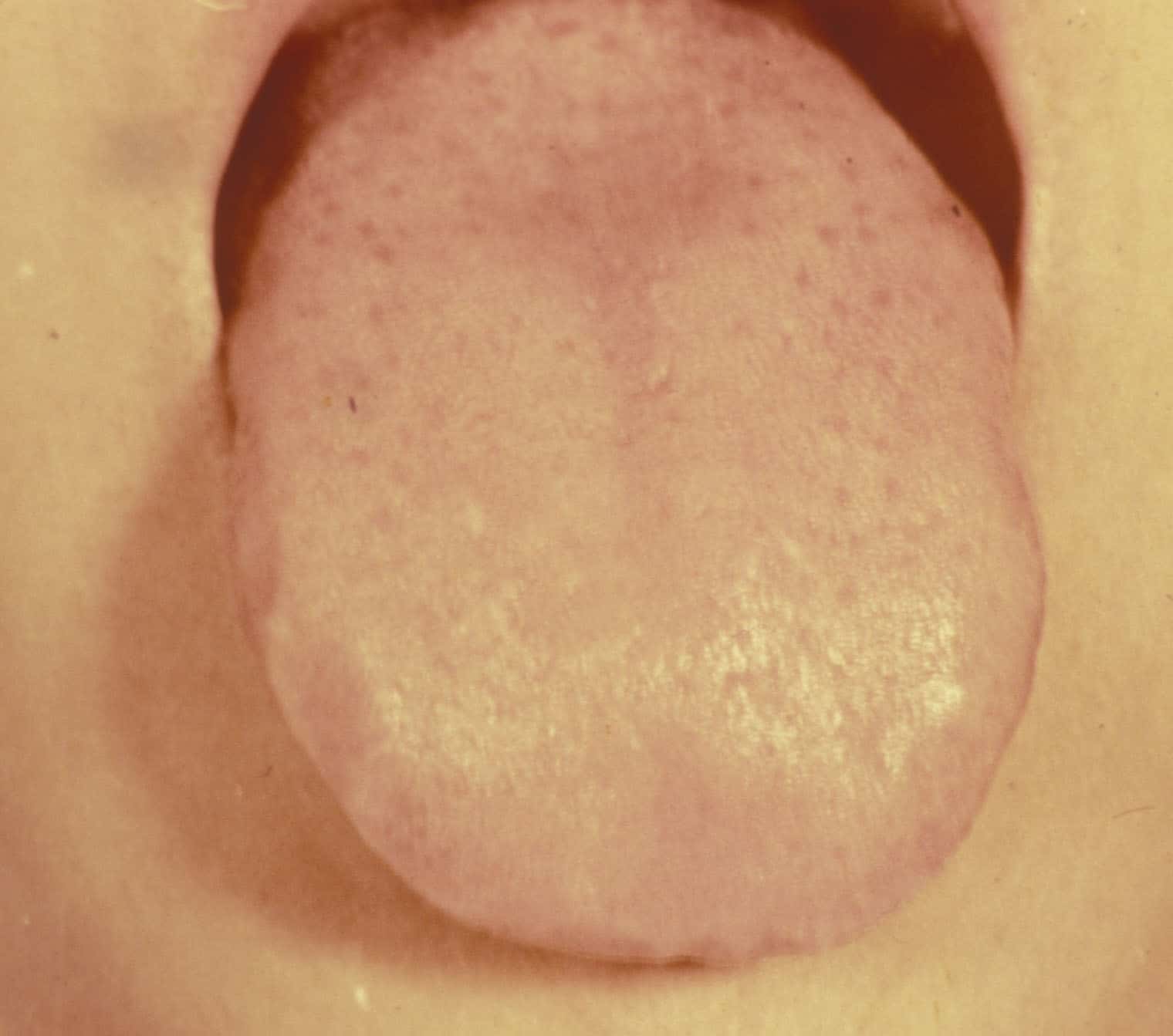 this is what your tongue may look like if you need Gui Pi Tang. Pale-"ish", maybe a slight, slight coating.